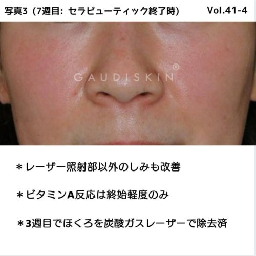 レーザー併用GAUDISKINセラピューティック治療7週間の実際 – GAUDISKIN