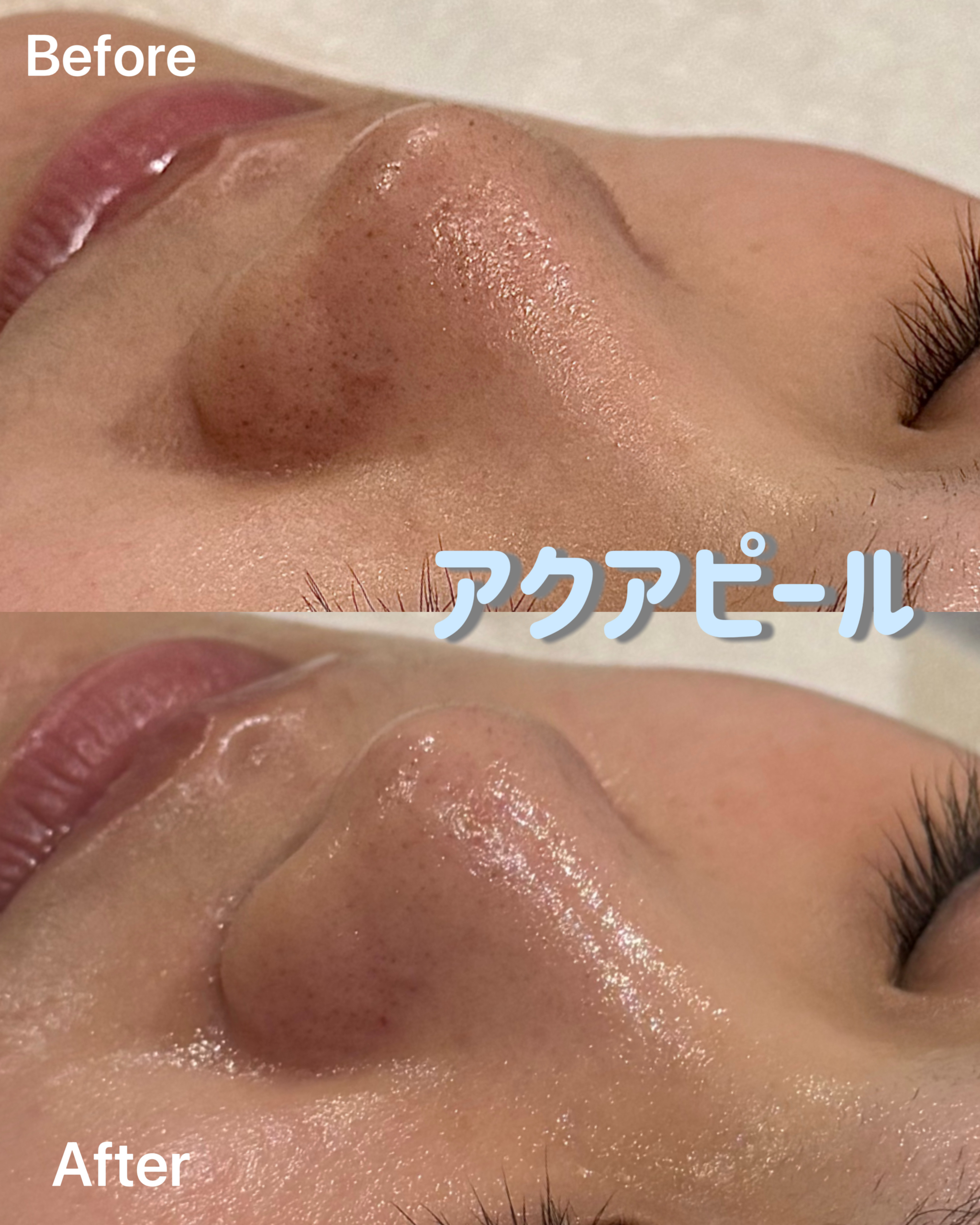 冬こそアクアピーリング❄️ | eyedeal