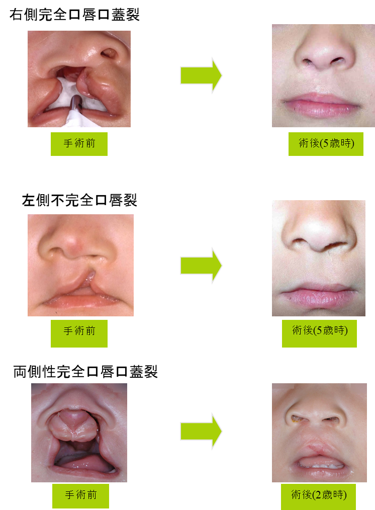 口唇口蓋裂外来 | 山口大学 歯科口腔外科