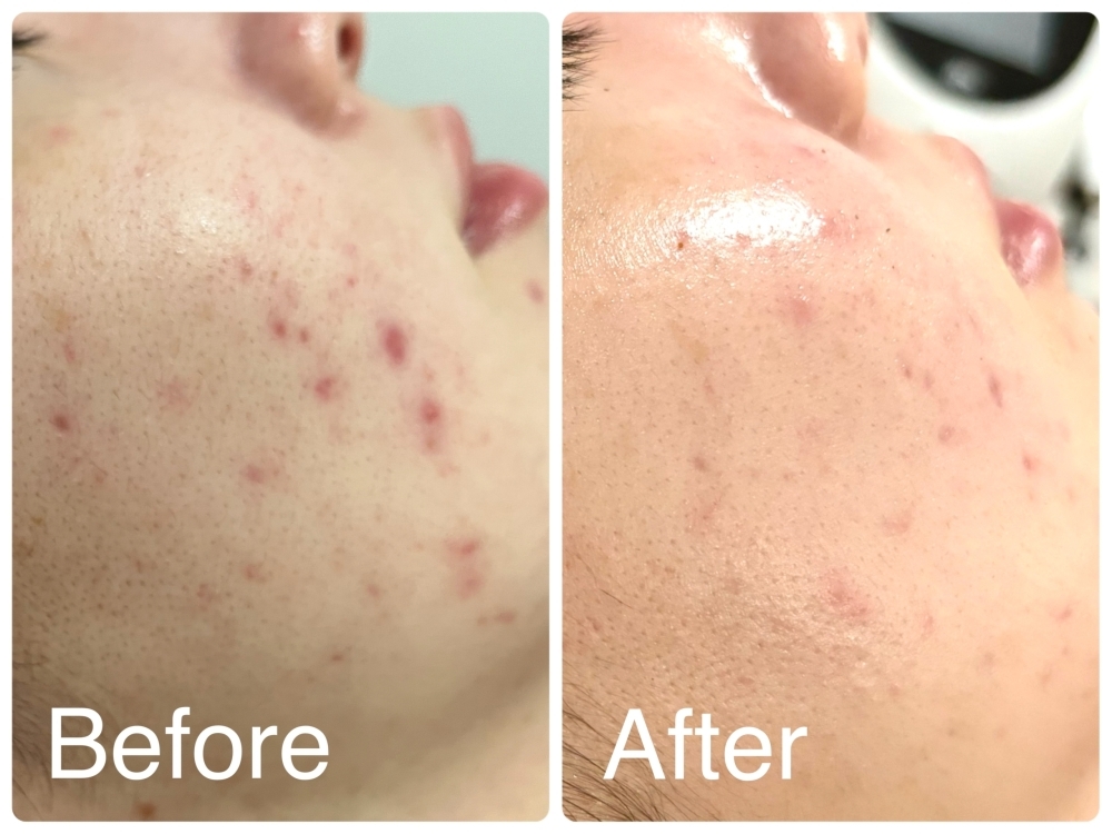 ニキビ・ニキビ跡改善 3回目】プラズマとハーブの力で早期改善例