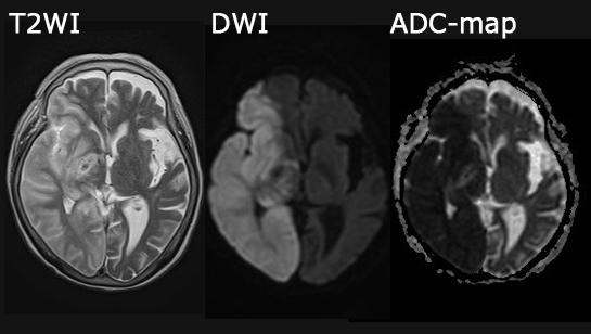 新人必見］簡単に脳梗塞（CTとMRI）の診断に役に立つ経時的変化を