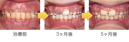 小児矯正治療（フェイシャルマスク） | 松本市の歯科医院、犬飼歯科