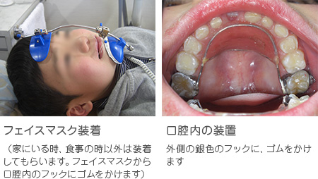 小児矯正治療（フェイシャルマスク） | 松本市の歯科医院、犬飼歯科