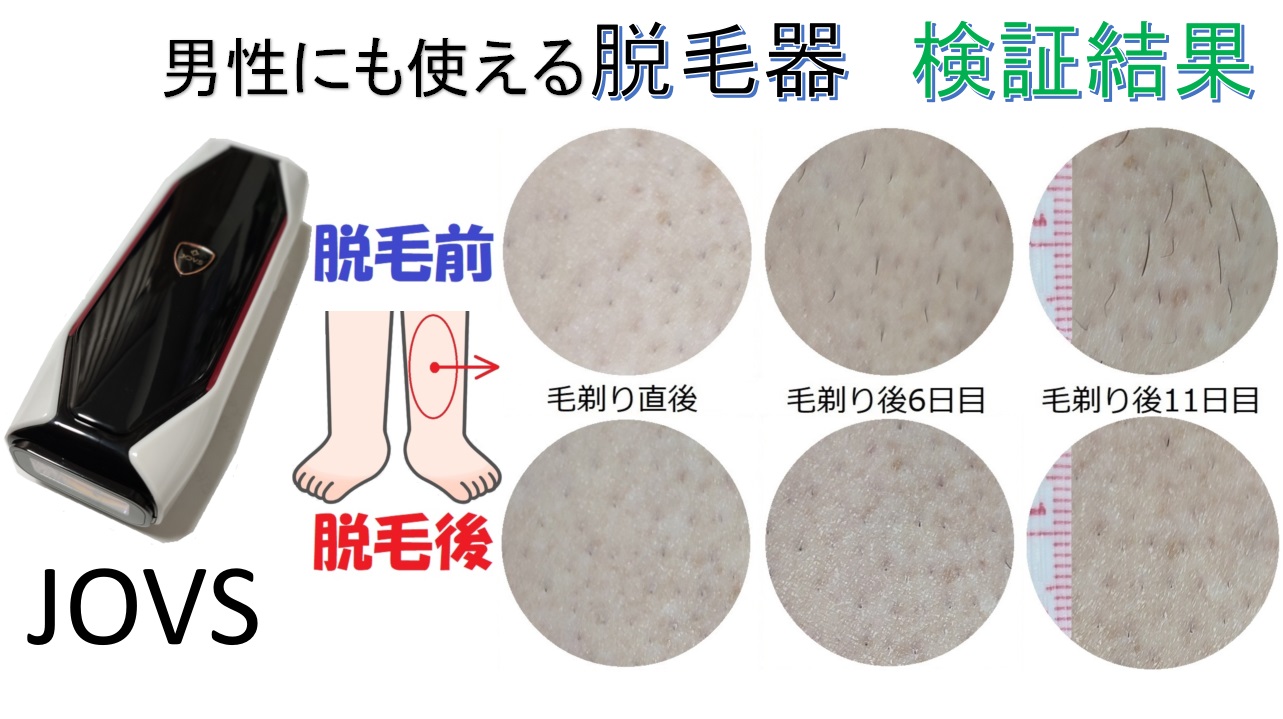 家庭用脱毛器（JOVS） を購入したので、その効果を検証する | たんてっ