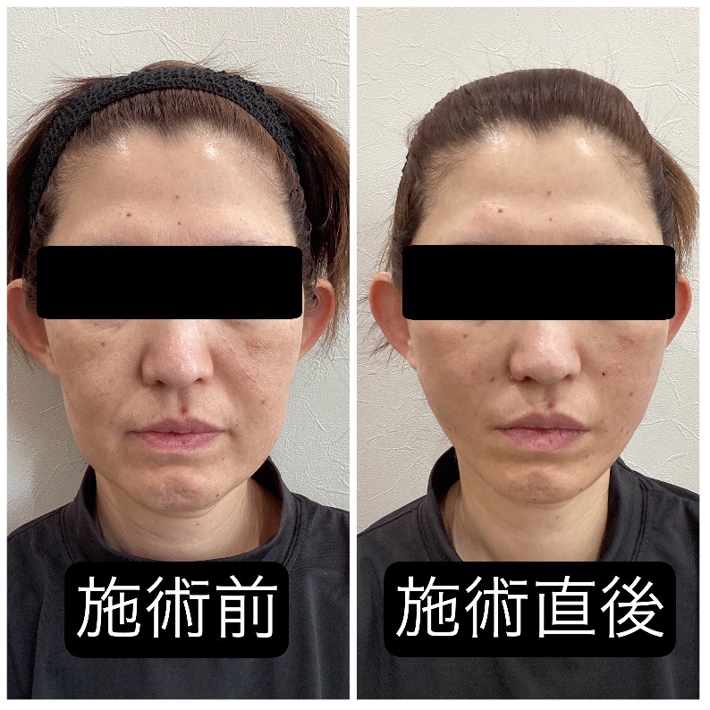 切らないフェイスリフト は恵比寿・代官山・中目黒の東京エビスクリニック