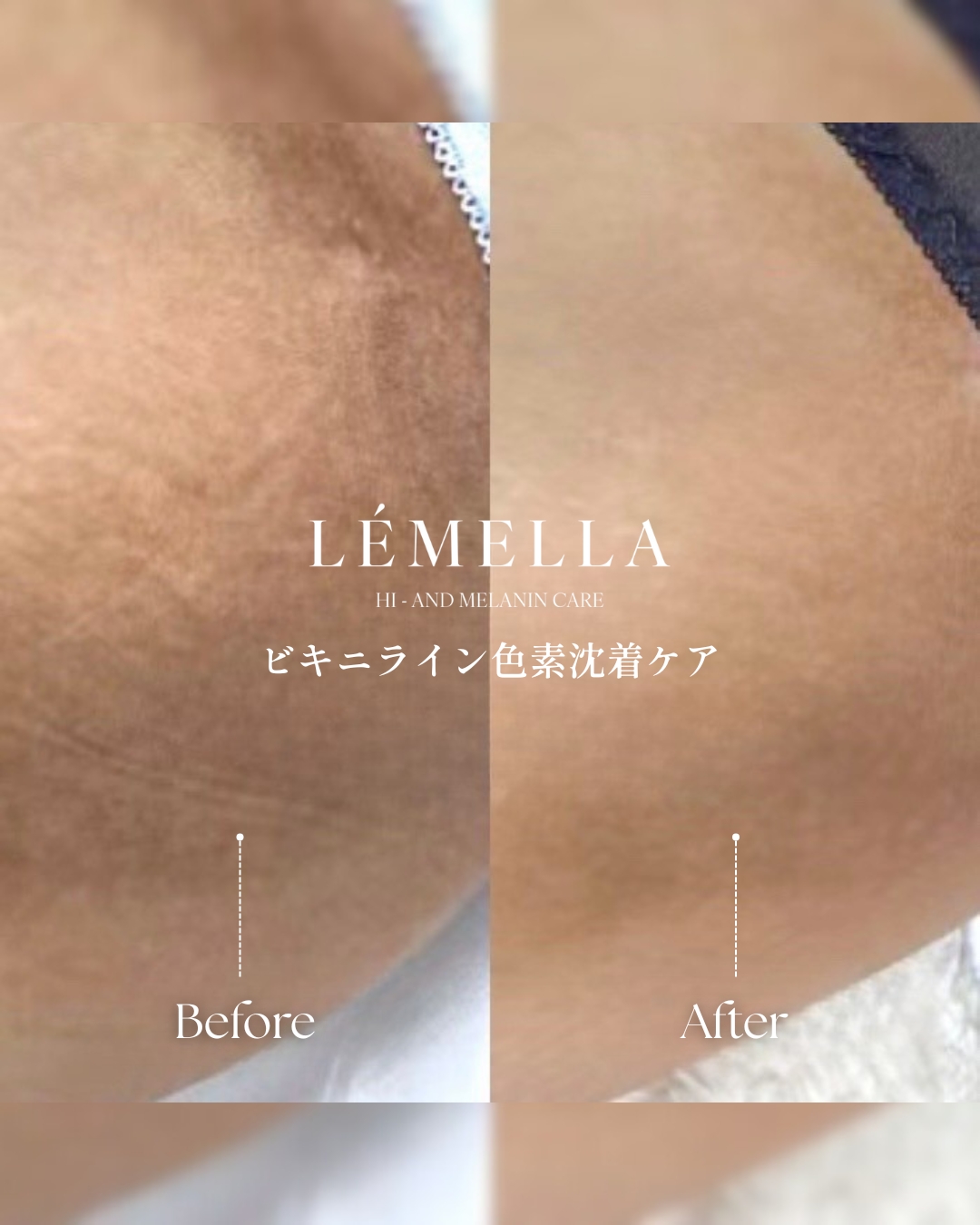 ルメラ（LEMELLA）メラニンケア｜豊橋の美容皮膚科 遠山クリニック