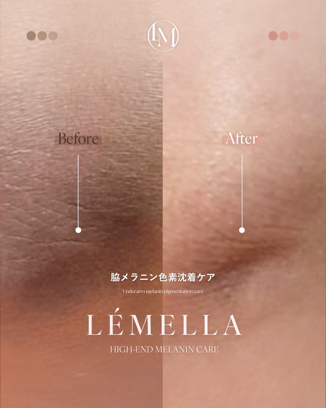 ルメラ（LEMELLA）メラニンケア｜豊橋の美容皮膚科 遠山クリニック