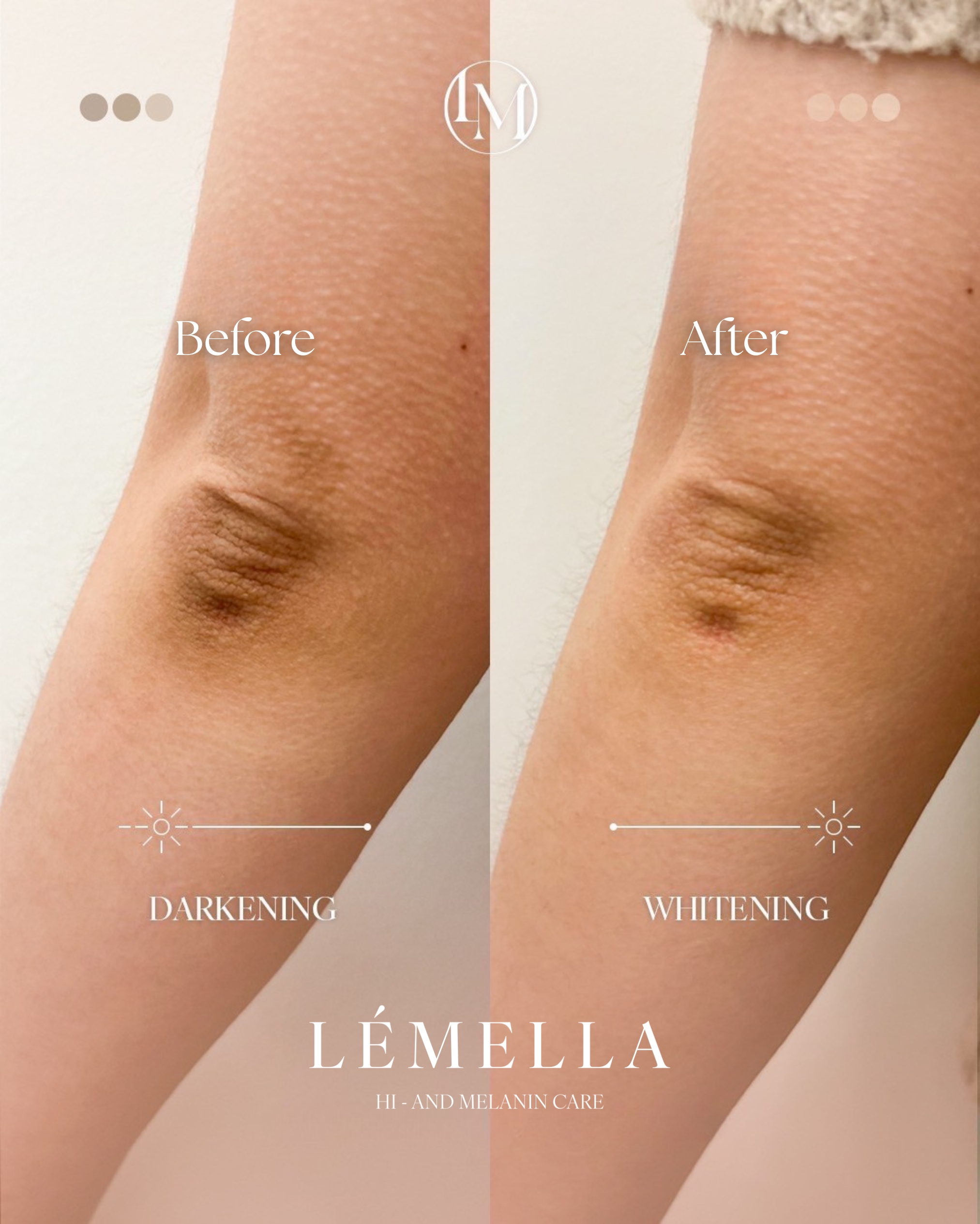 ルメラ（LEMELLA）メラニンケア｜豊橋の美容皮膚科 遠山クリニック