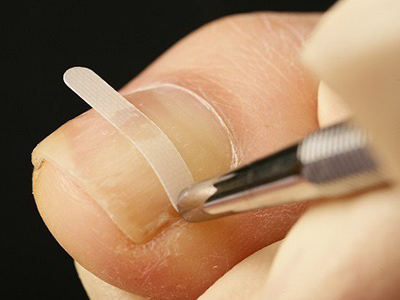 施術方法・流れ｜豊中の巻き爪ケア｜豊中駅より徒歩1分でアクセス抜群