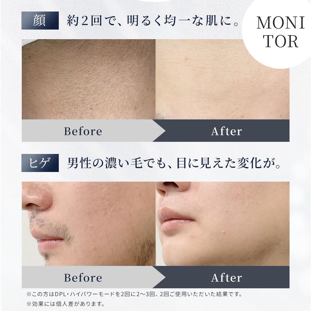 楽天市場】［4,830円！クーポンで◎スーパーSALE×newlife2026］ 脱毛器