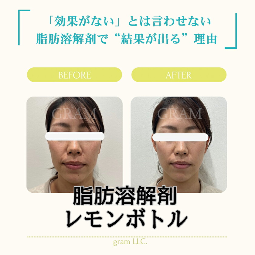 楽天市場】エステ版ポテンツァ DermaFUSE 資料請求 / 韓国美容 水光肌