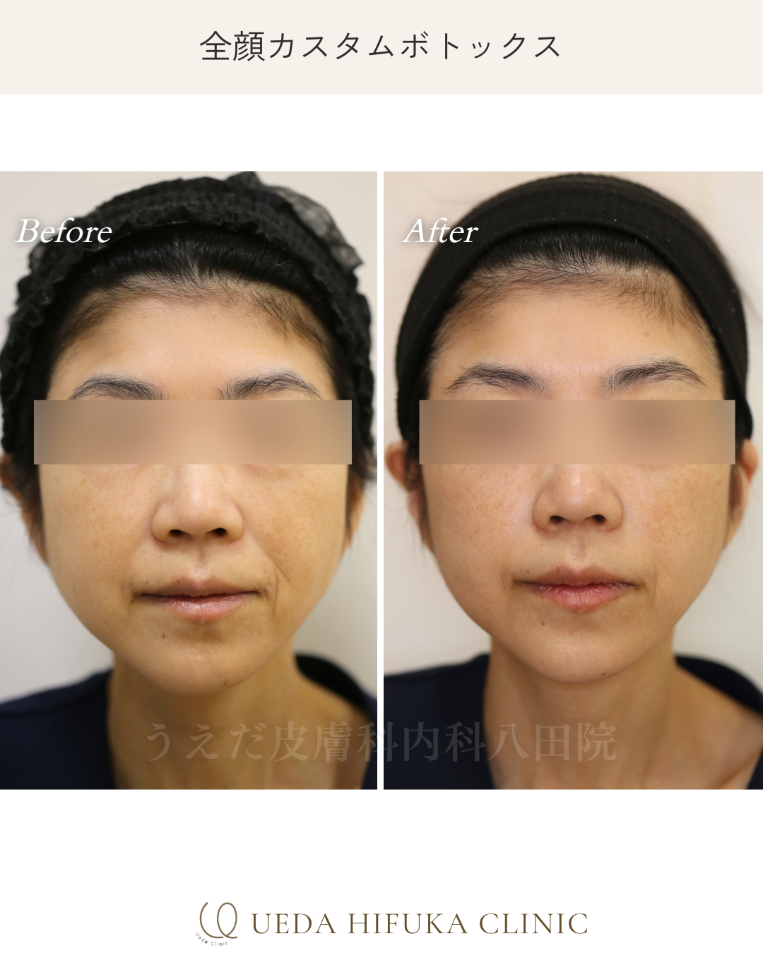 ボトックス注射【Case No.182】 | うえだ皮膚科内科 八田院 | 名古屋市