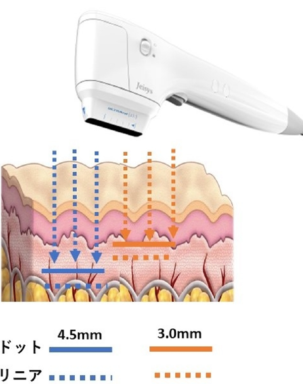 切らないリフトアップ「HIFU（ハイフ） ウルトラセルZi」は