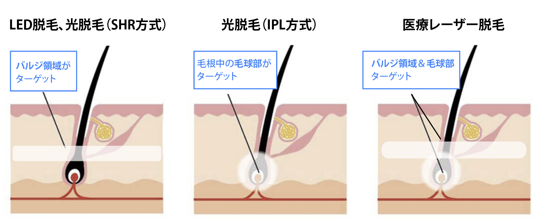 LED脱毛と光脱毛＆医療レーザー脱毛の違い | 株式会社Dr.Visea