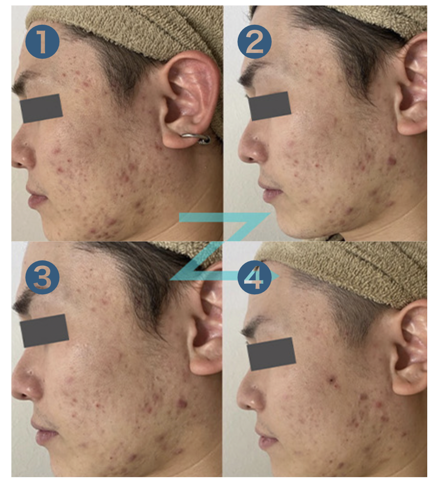 Dr.Viseaのプラズマ美顔器『シミプラズマネオ』ついて顧問教授に