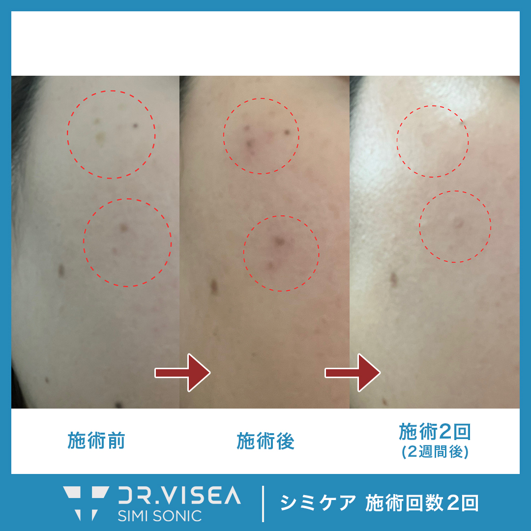 シミソニック※現在生産終了 | 株式会社Dr.Visea/ドクタービセア