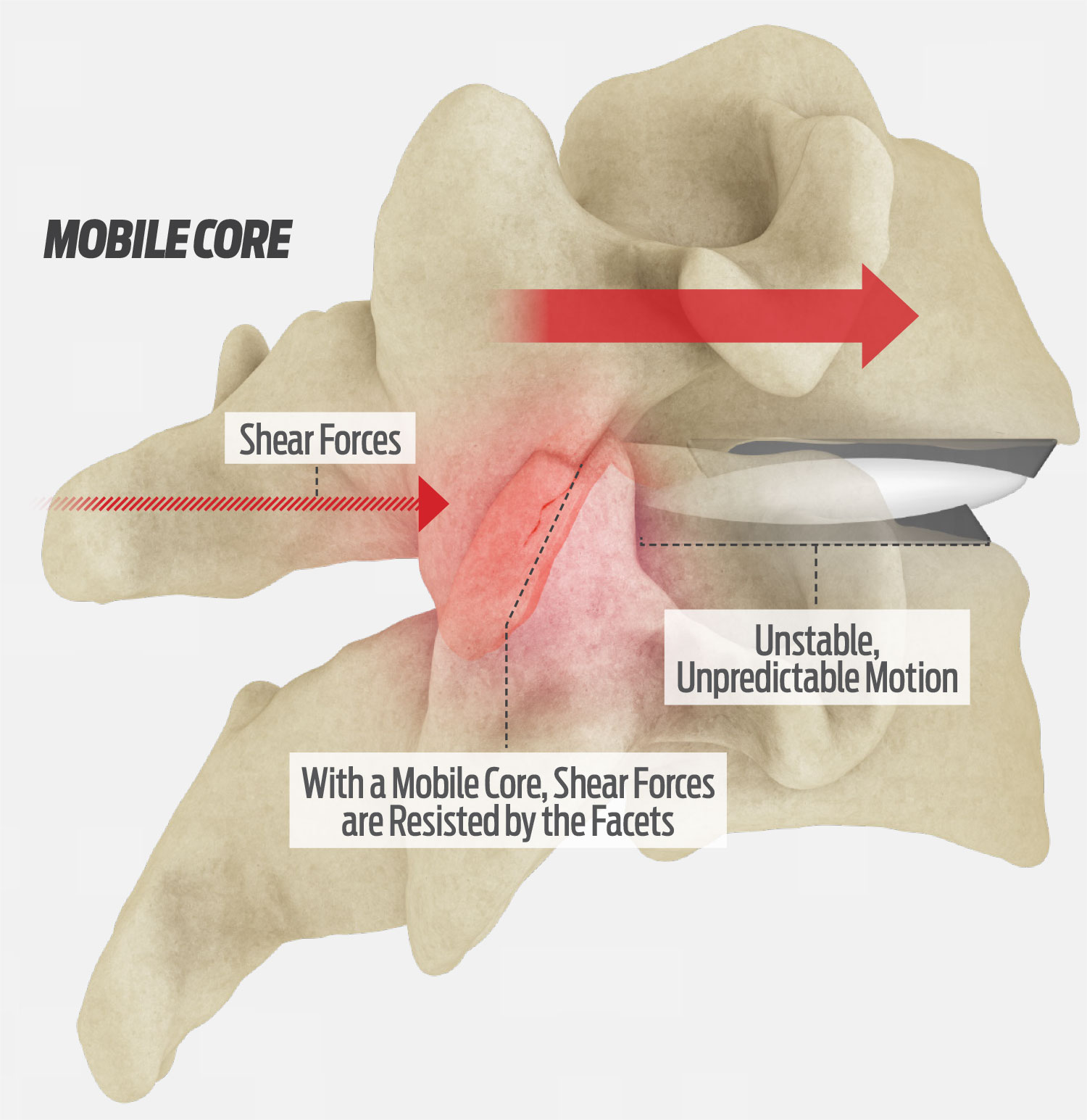 Centinel Spine | For prodisc® Motion-Preservation/Disc