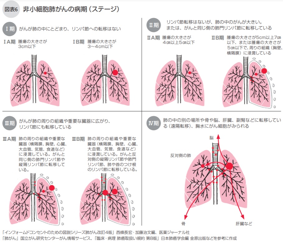 肺がんの病期（ステージ） | NPO法人キャンサーネットジャパン