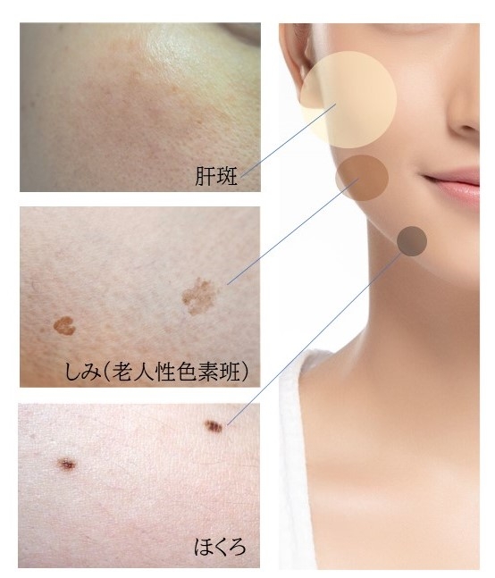 しみ・ほくろレーザー治療