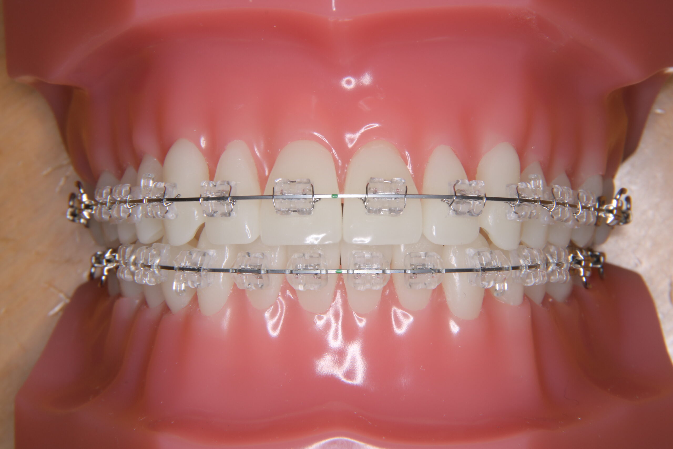 ブラケットの種類 - あかつき矯正歯科クリニック