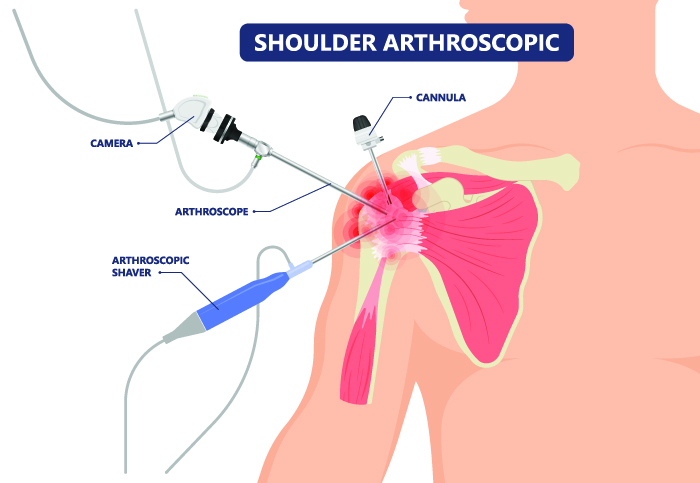 カンプールのチュニガンジで最高の肩関節鏡検査 | アポロ・スペクトラ