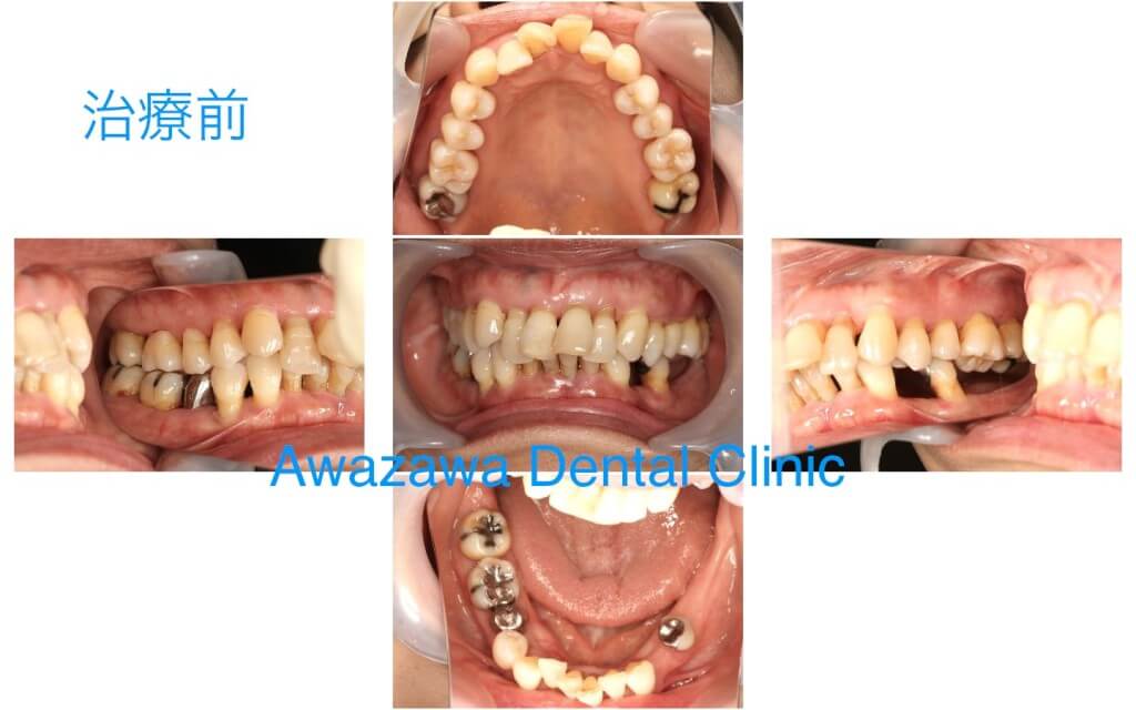 インプラント症例 | 深谷市の粟澤歯科医院