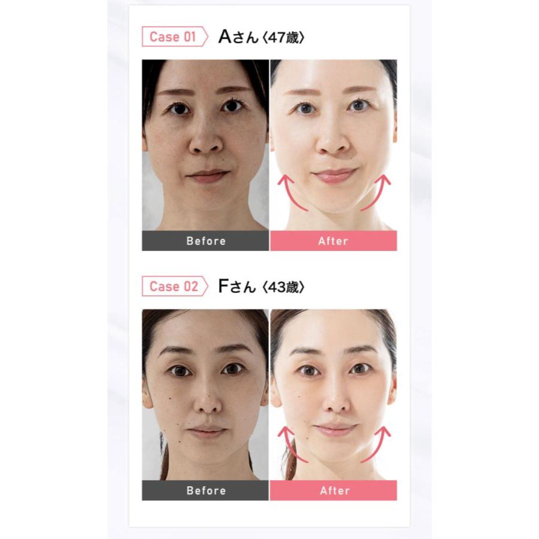 SKIN IRON(スキンアイロン） | 美容家電のサブスク・レンタルなら