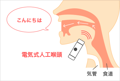 電動式人工喉頭 ユアトーン｜第一医科株式会社