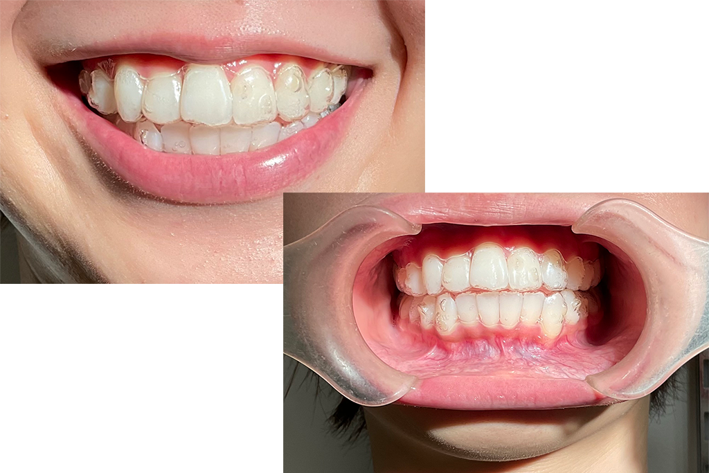 マウスピース型矯正装置(インビザライン)｜金沢市寺町の歯科・歯医者