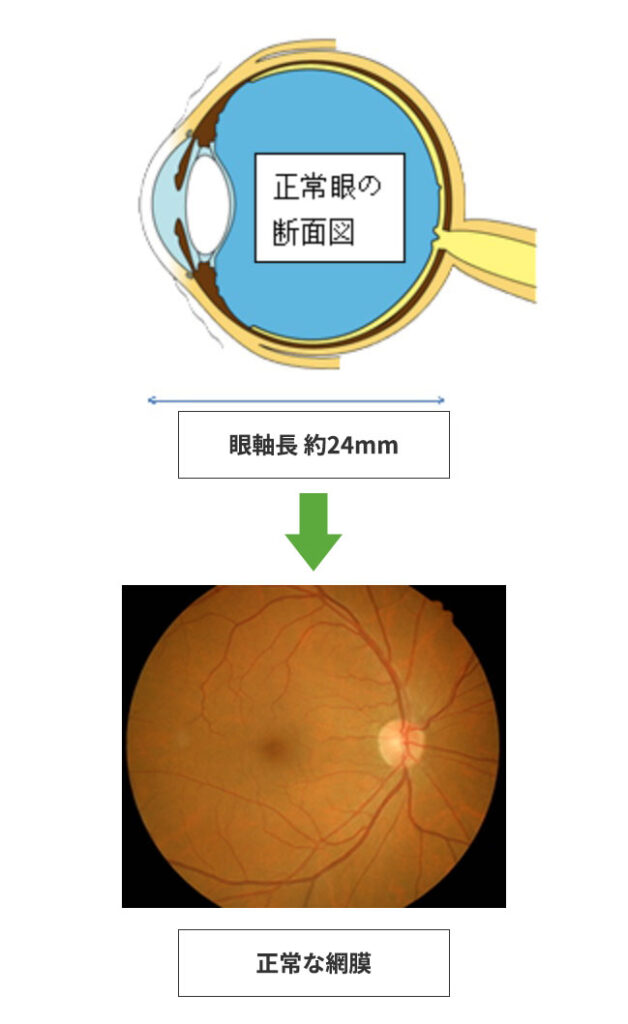 小児の近視抑制治療 | 多治見市の近視抑制治療なら倉知眼科