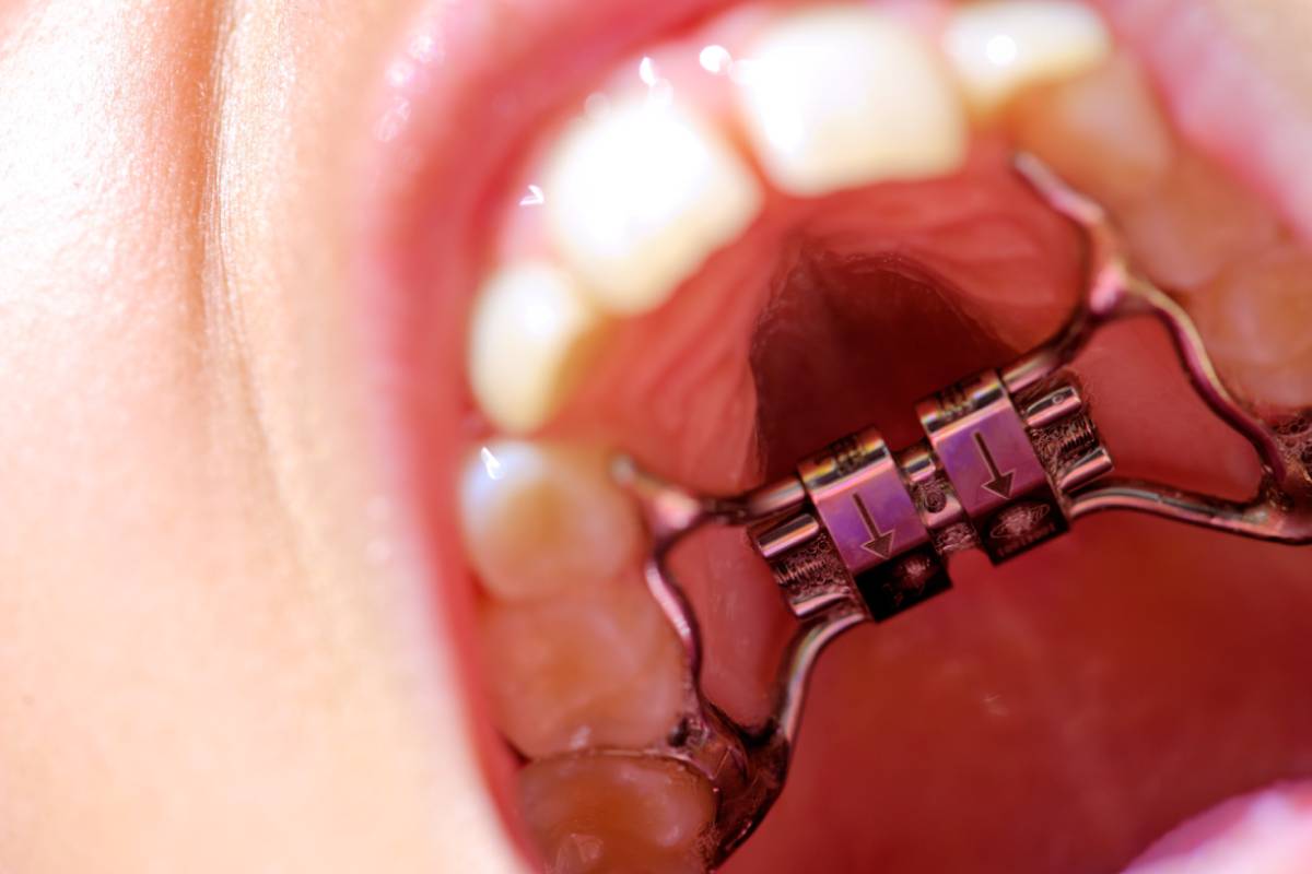 治療例つき】拡大床（かくだいしょう）とは？小児の床矯正で顎を拡大