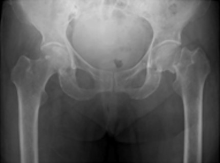 大腿骨近位部骨折｜疾患ガイド｜患者さん向けガイド｜原三信病院