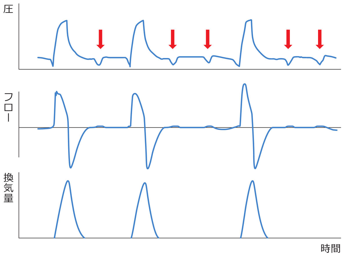 どうする？ 人工呼吸器非同調 発見と対策のポイント | アイ・エム
