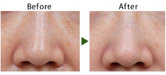 ハイドラブースター(ハイドラフェイシャル)｜京都・滋賀の大西皮フ科