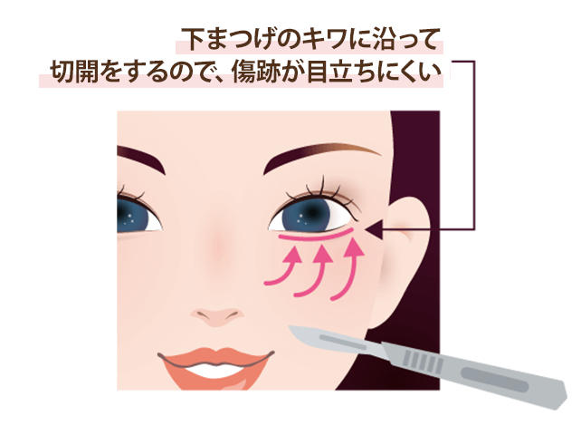 ミッドフェイスリフト｜オザキクリニックLUXE 新宿院（目黒祐天寺・羽村）