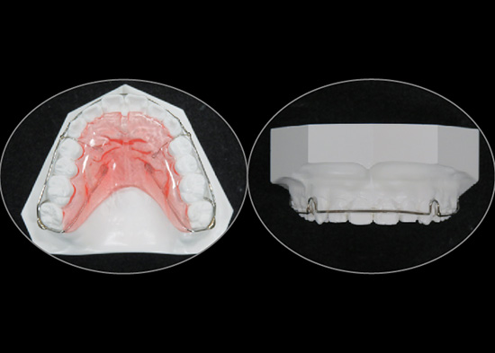 治療後の保定（リテーナー）｜茨木市の歯医者（歯科医院）「みやの矯正