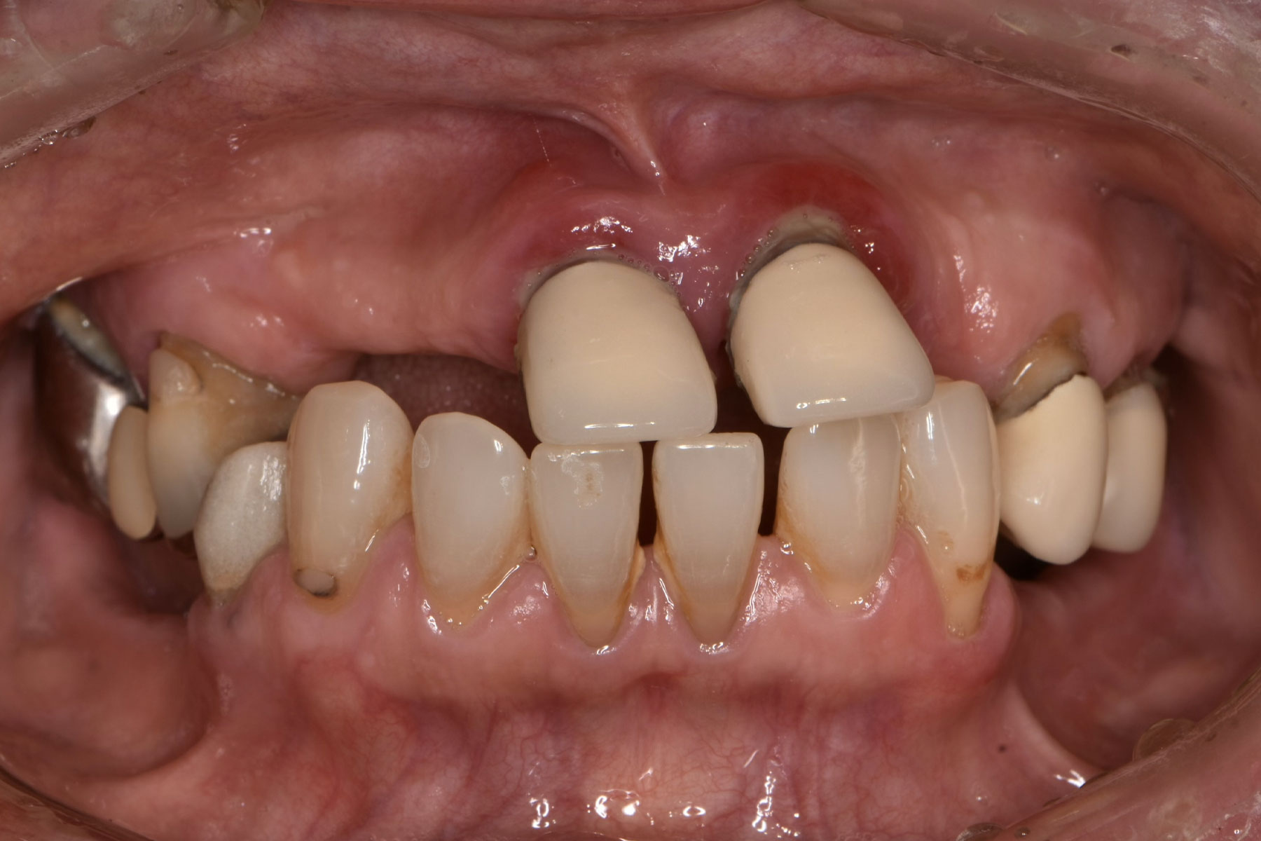 オールオン6】歯がボロボロで食事が出来ない - 仙台市宮城野区の歯医者