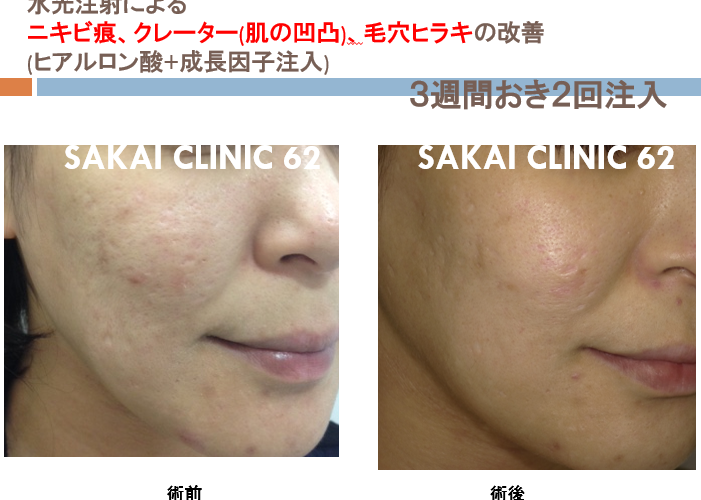 水光注射について（ブログ） | sakai-clinic62