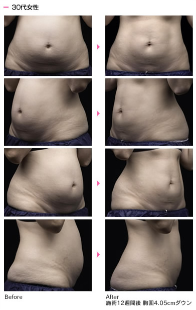 ライポソニックス（Liposonix）| ボディ・医療痩身｜北九州の美容外科