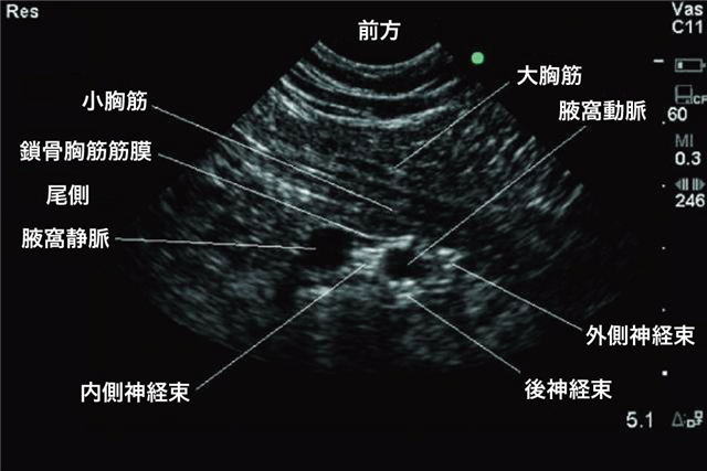 神経ブロック：鎖骨下神経（超音波ガイド） - Procedures Consult