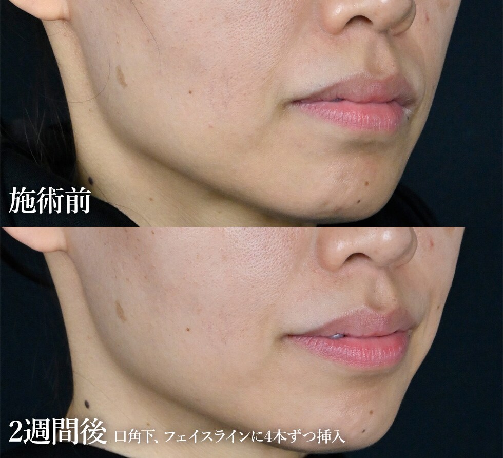 SBCトキシルスレッド～女優注射®成分配合～｜若返り・エイジングケア