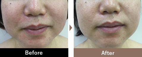 ベビースキン（臍帯血幹細胞培養上清液）｜美容皮膚科なら湘南美容