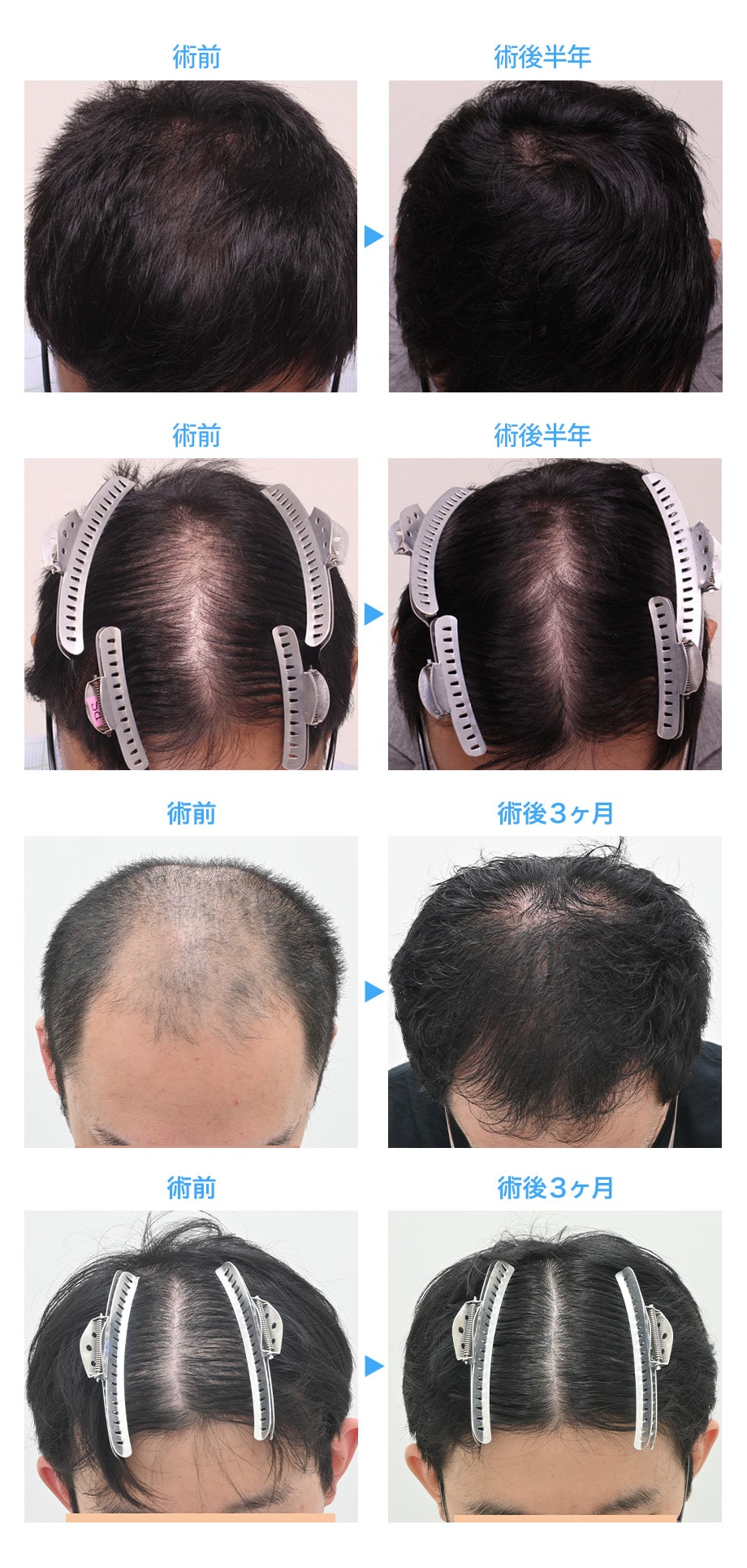 AGA院限定治療】強く太い髪の毛に！AGA治療の概念を覆す新理論の薄毛