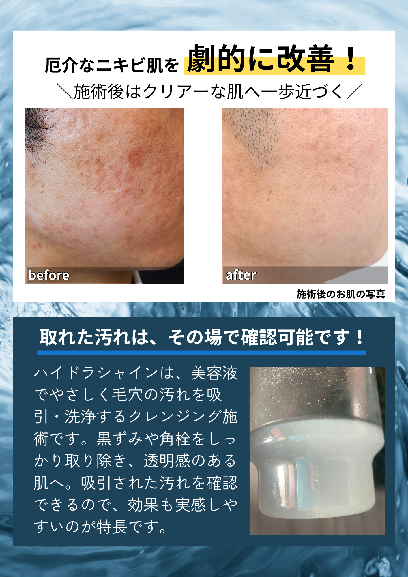 毛穴洗浄｜TODAY-滋賀県草津市の完全予約制メンズ脱毛サロン