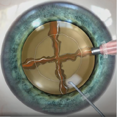 新時代の白内障手術システムPerfect Z-CATARACT System - 白内障手術