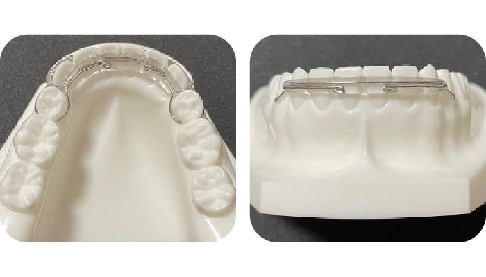 矯正装置紹介｜稲毛駅徒歩3分の矯正歯科｜つみき矯正歯科稲毛