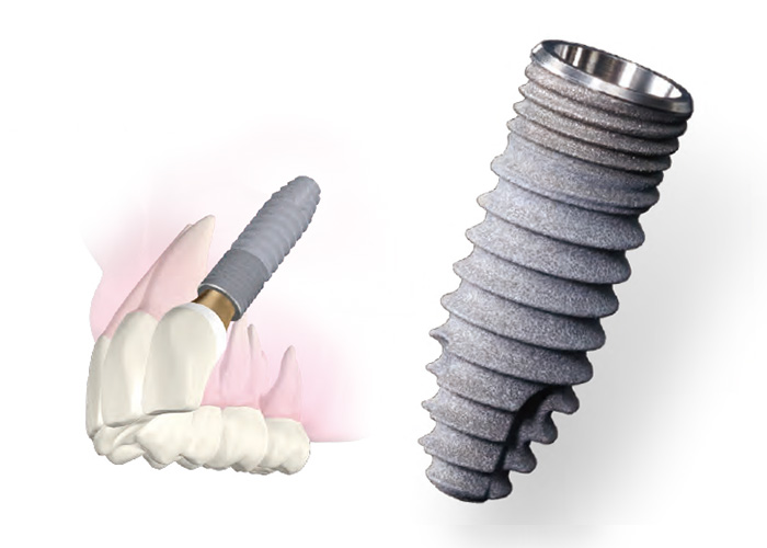 インプラントは兵庫県神戸市灘区の神戸六甲インプラントテクニカル
