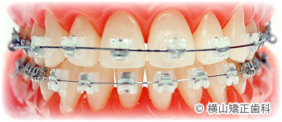 大人の矯正装置 | 横山矯正歯科 公式サイト横山矯正歯科 公式サイト