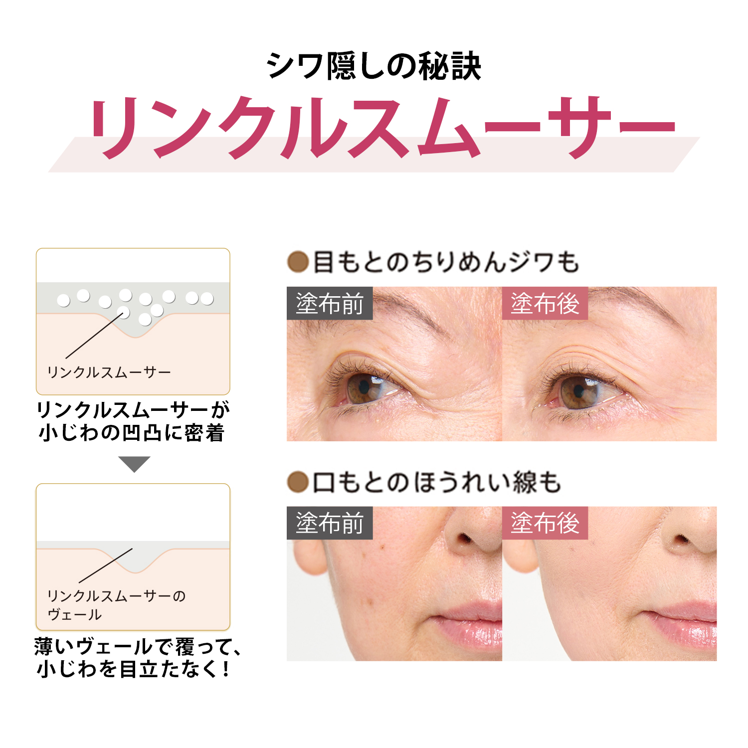 メディリフト ニードルリフト リンクルスムースベース｜ヤーマン公式