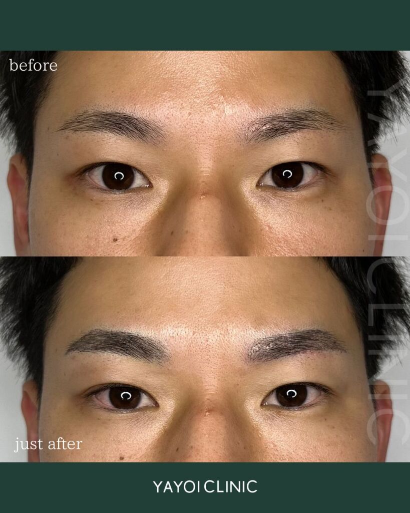 アートメイク(医療）｜広島 ヤヨイクリニック（YAYOI CLINIC）美容皮膚科